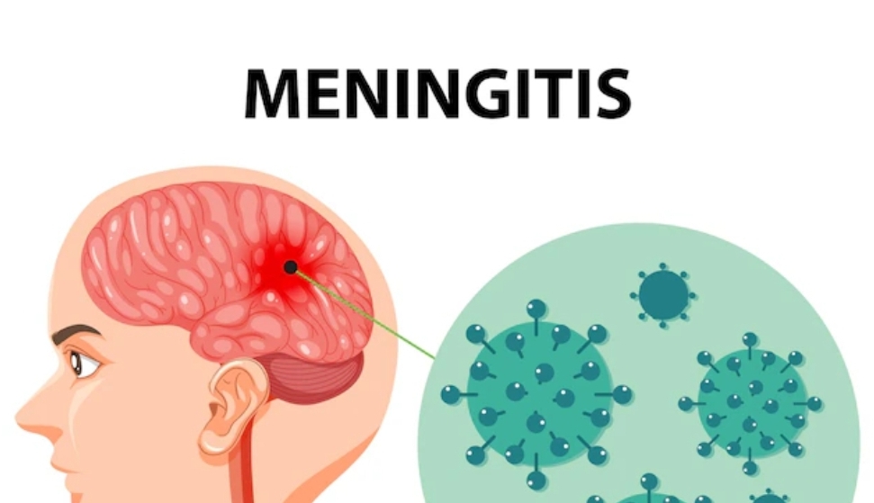 🏂เยื่อหุ้มสมองอักเสบ Meningitis